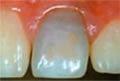 Vor der Bleaching-Behandlung