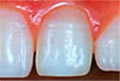 Nach der Bleaching-Behandlung