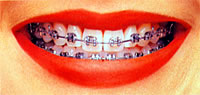 herkömmliche Metall-Brackets