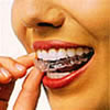 invisalign 2