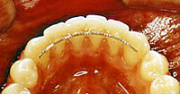 Fixed-Retainer