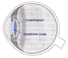 Kunstlinse