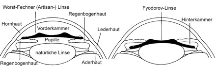 Worst-Fechner-Linse