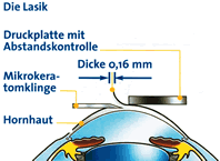 Excimer-Laser