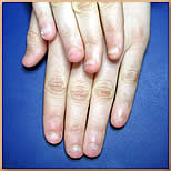 Nagelbei�er-Fingern�gel vor der Behandlung