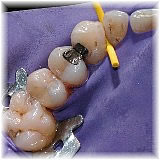 Mercury free and mercury safe dentistry, dentist weiden, dental office grafenwoehr
