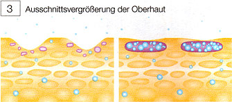 Hyaluronic Filling Spheres