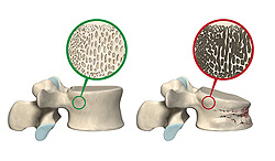 Knochenschwund (Osteoporose) kann zu Witwenbuckel und Br&uuml;chen f&uuml;hren - die Knochendichtemessung durch Ultraschall dient der Fr&uuml;herkennung und Vorsorge