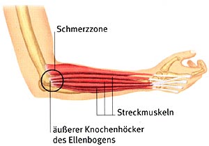 Tennisarm, Golfarm, Mausarm