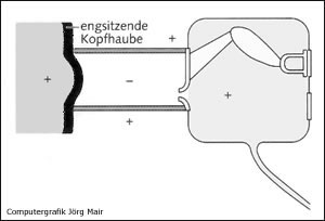 Barotrauma des Geh�rgangs