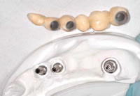 6-gliedrige Brücke auf Implantaten
