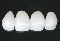 Luminiers, Veneers, Vollporzelankronen