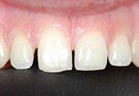 Pink & White Esthetics vorher