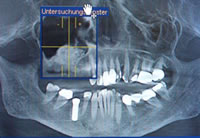 Implantat möglich durch Knochenaufbau