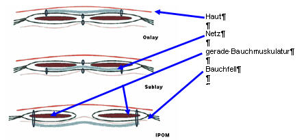 Bauchdecke