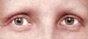 Permanent make-up f�r strahlende Augen - Diese Dame besitzt keine Wimpern und Brauen mehr. Das Gesicht erscheint dadurch nackt. Die Ausstrahlung fehlt und das kann sehr belasten.