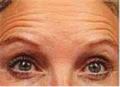 Botox - vorher