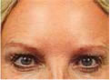 Botox - nachher