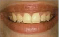 Power-Bleaching - vorher