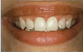 Power-Bleaching - nachher