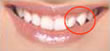 Veneers - Im roten Kreis k�nnen wir die L�cke erkennen. Das Lachendie sieht unvollst�ndig aus.