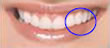 Die Veneers - Behandlung war erfolgreich. Die Z�hne sind strahlend und das Lachen ist wieder komplett!