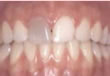 Power Bleaching - vorher