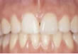 Power Bleaching  - nachher