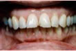 Veneer - vorher
