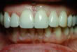 Veneer - nachher