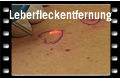 Leberflecken