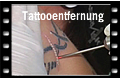 Tattooentfernung