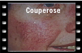 Couperose