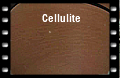 Cellulite