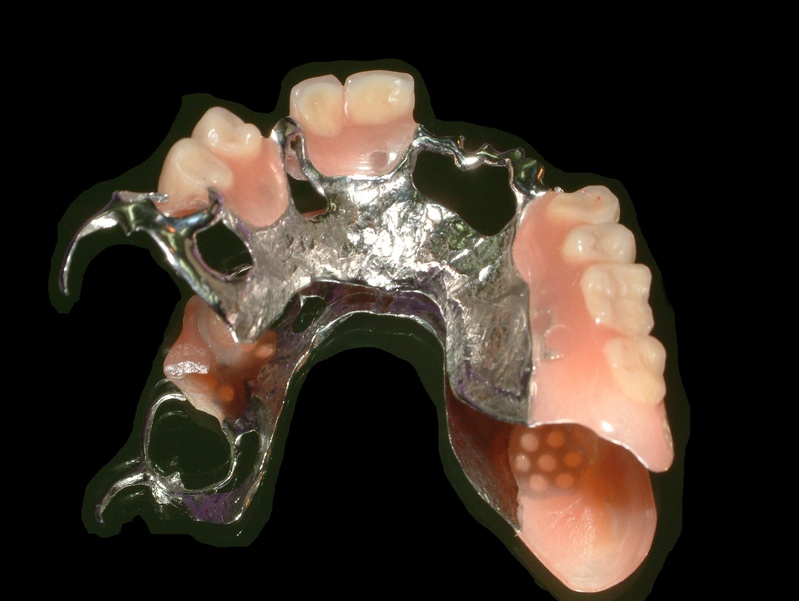 standard Metall-Klammerprothese