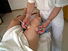 Cellulitebehandlung