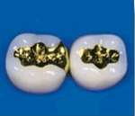 Zahnfüllung Gold