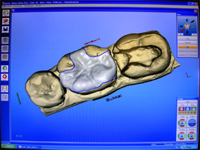 Cerec 3D-Rekonstruktion