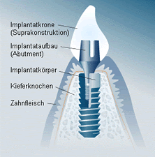 Zahnimplantate