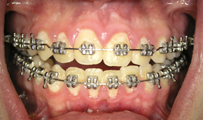 Festsitzende Spange mit Metallbrackets