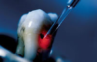 Dental-Laser