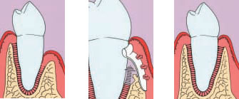 GBR+ GTR= guided bone regeneration+ guided tissue regeneration