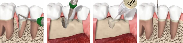 EMDOGAIN