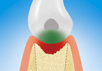 Knochenabbau mittel