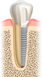 osseointegriertes Implantat