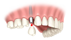 Krone auf Implantat
