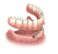 Steg auf 2 Implantaten