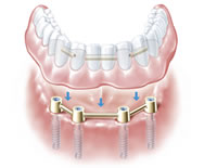 Steg auf 4 Implantaten