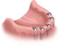 Fester Zahnersatz auf Implantaten