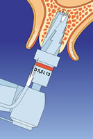 Implantatbettaufbereitung